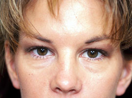 Lower Eyelid Blepharoplasty