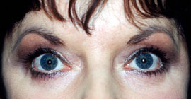 Lower Eyelid Blepharoplasty