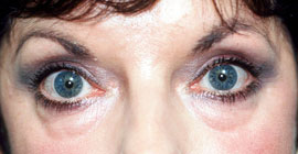 Lower Eyelid Blepharoplasty