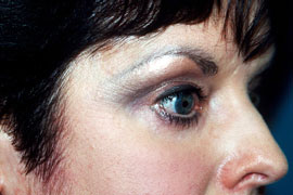 Lower Eyelid Blepharoplasty