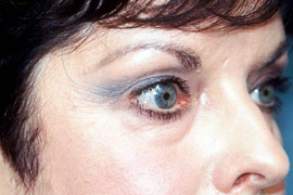 Lower Eyelid Blepharoplasty