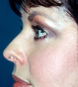 Lower Eyelid Blepharoplasty