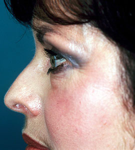 Lower Eyelid Blepharoplasty