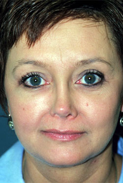 Upper Eyelid Blepharoplasty