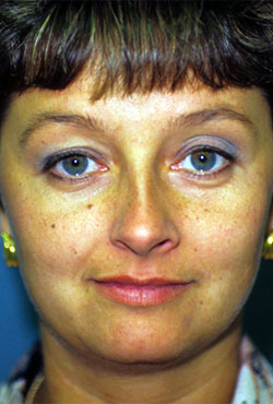 Upper Eyelid Blepharoplasty