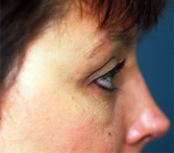 Upper Eyelid Blepharoplasty