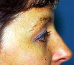 Upper Eyelid Blepharoplasty