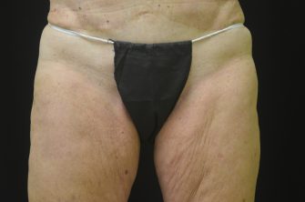 Coolsculpting®