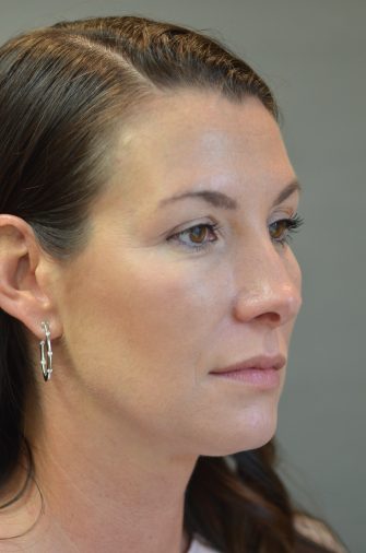 Radiesse Injections