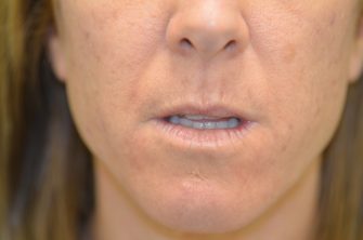 DOT Laser Resurfacing