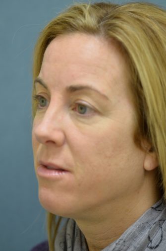 DOT Laser Resurfacing