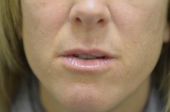 DOT Laser Resurfacing