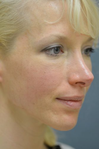 Restylane Injections