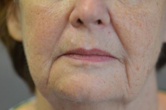 DOT Laser Resurfacing