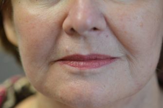 DOT Laser Resurfacing