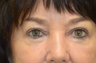 Lower Eyelid Blepharoplasty