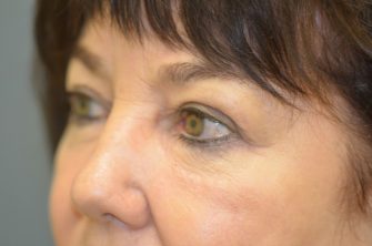 Lower Eyelid Blepharoplasty