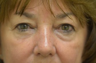 Lower Eyelid Blepharoplasty