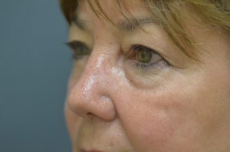 Lower Eyelid Blepharoplasty