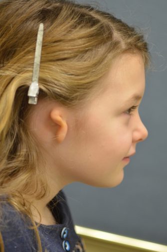 Ear Reconstruction (Microtia Reconstruction)