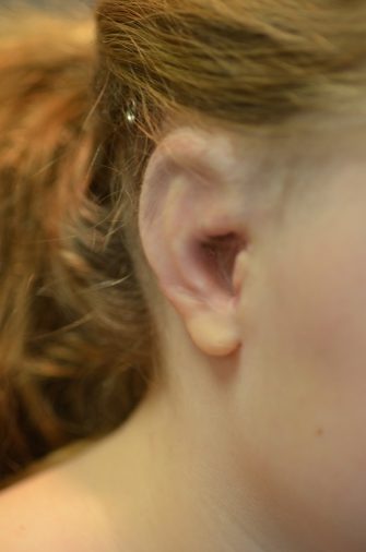 Ear Reconstruction (Microtia Reconstruction)