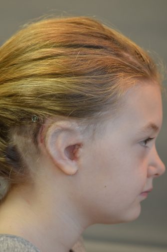 Ear Reconstruction (Microtia Reconstruction)