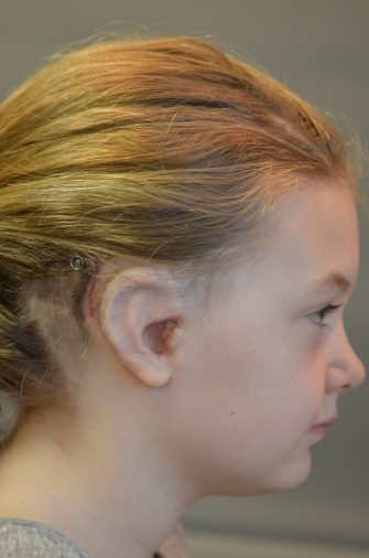 Ear Reconstruction (Microtia Reconstruction)