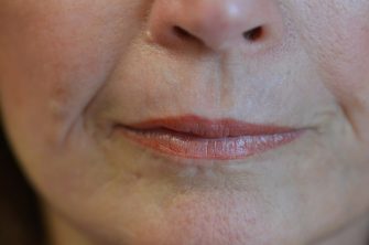 DOT Laser Resurfacing