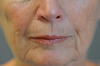 DOT Laser Resurfacing